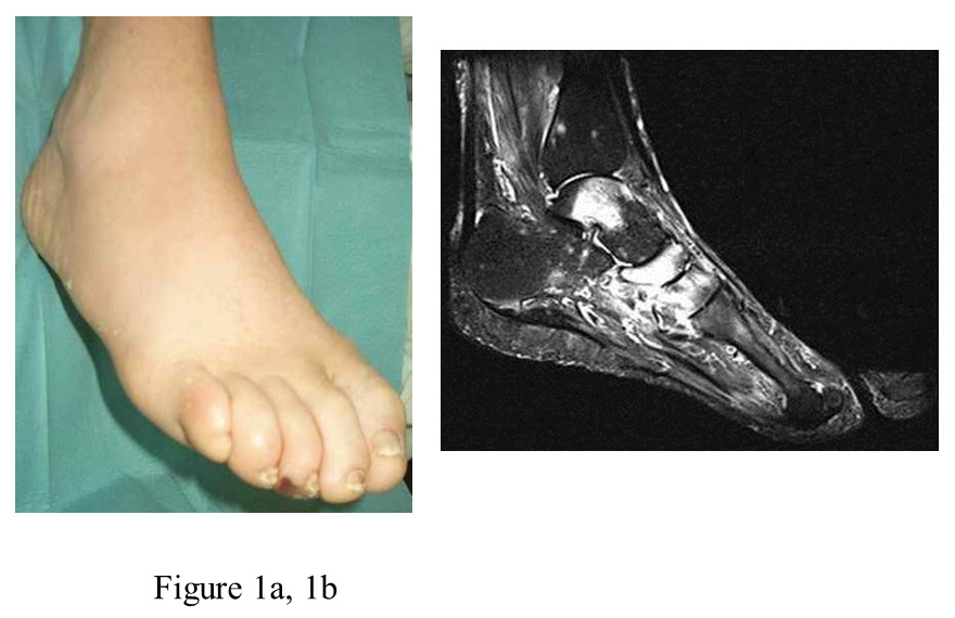 The Acute Diabetic Charcot Foot Managed On The Basis Of Magnetic
