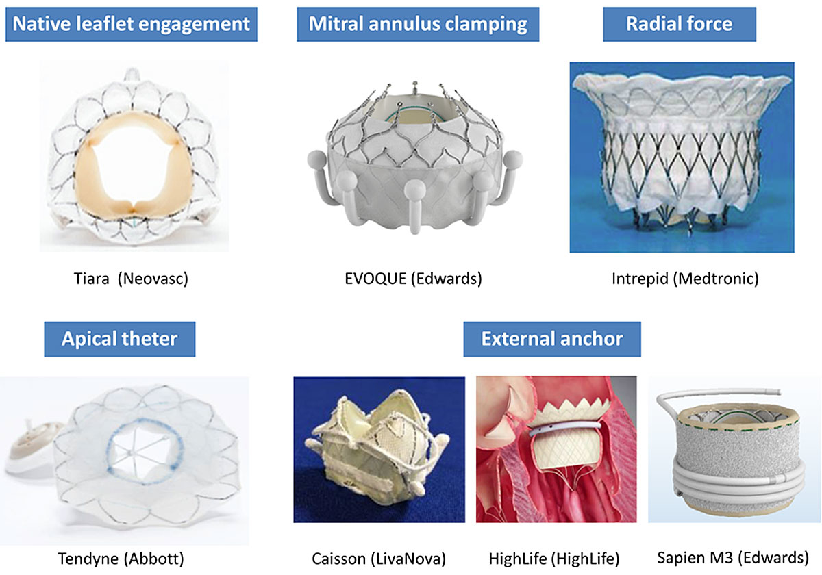 MRI evaluation prior to Transcatheter Aortic Valve Implantation (TAVI):  When to acquire and how to interpret | Insights into Imaging | Full Text