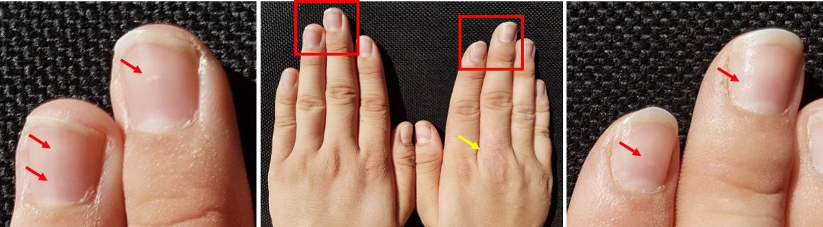 Nails tell a lot about your health, here are the changes that happen and  what they mean - Shëndeti