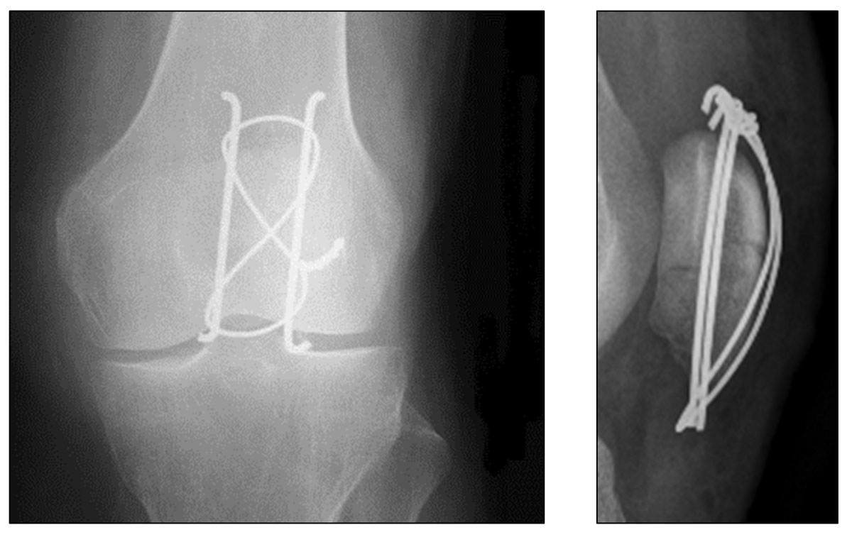 Practical guidelines for the treatment of patellar fractures in adults